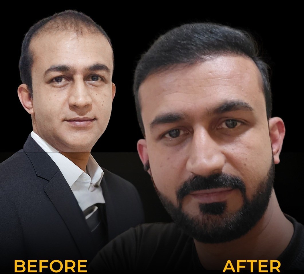 Hair Transplant Results Timeline