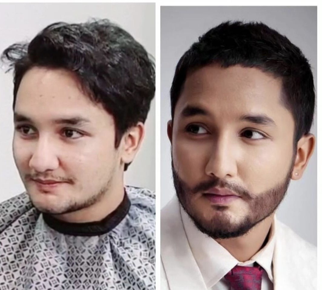 Hair Transplant Results Timeline